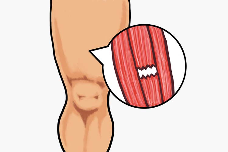 筋断裂（肉離れ）画像