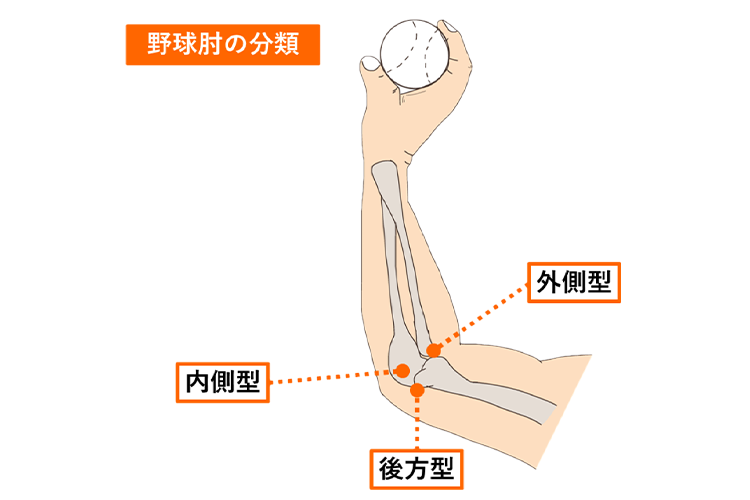 野球肘画像