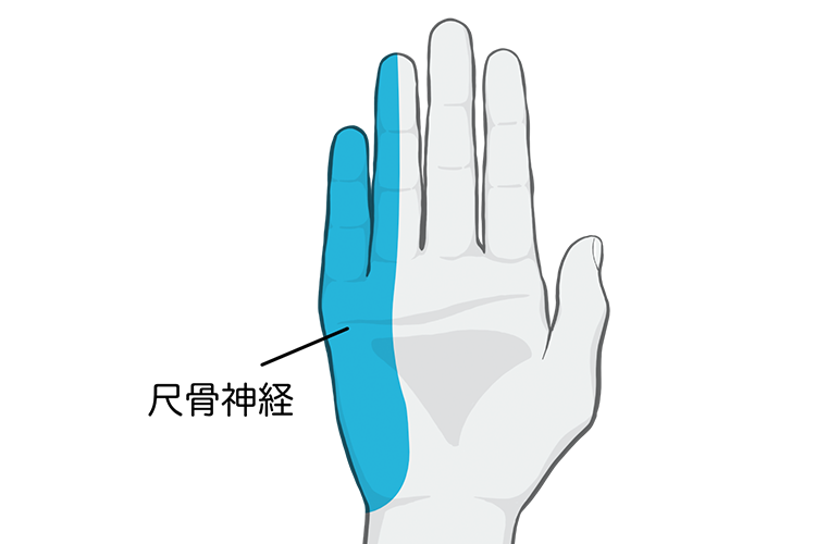 肘部管症候群（尺骨神経障害）画像