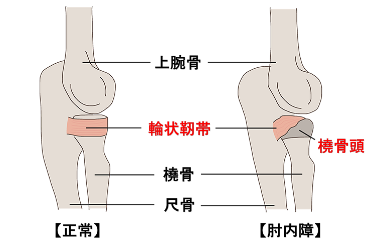 肘内障画像