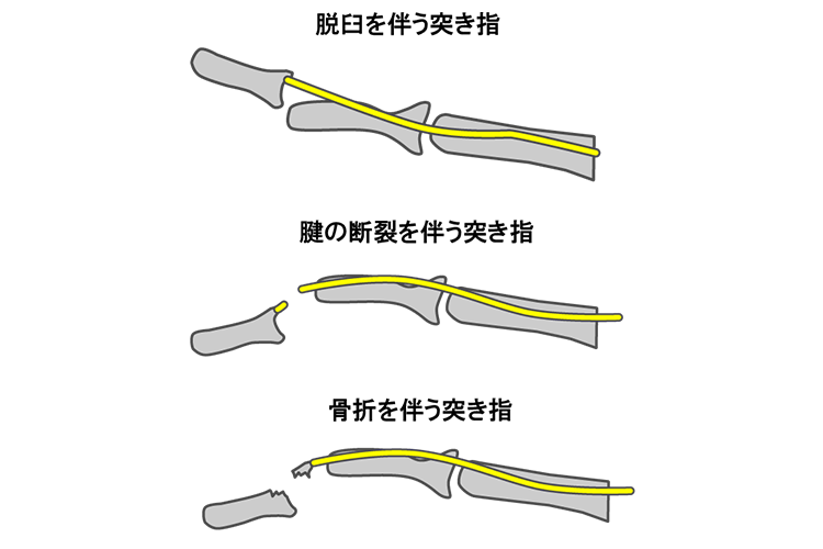 突き指（マレット変形）画像