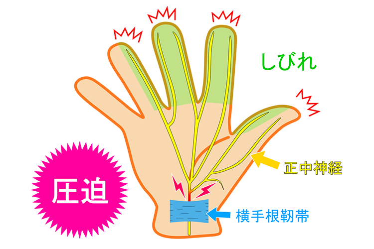 手根管症候群画像