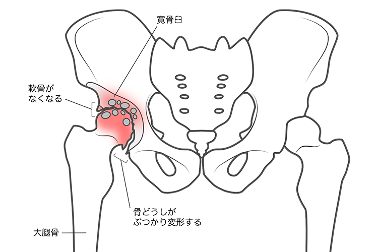 変形性股関節症画像