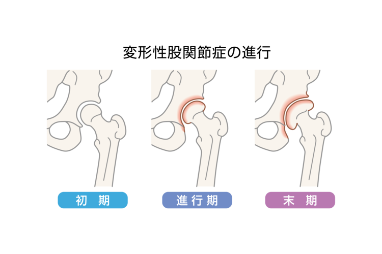 変形性股関節症画像