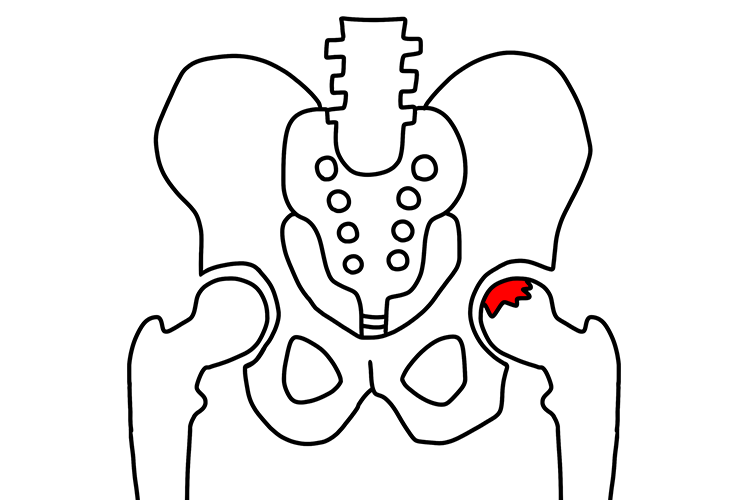 特発性大腿骨骨頭壊死画像