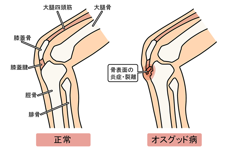 オスグッド病画像