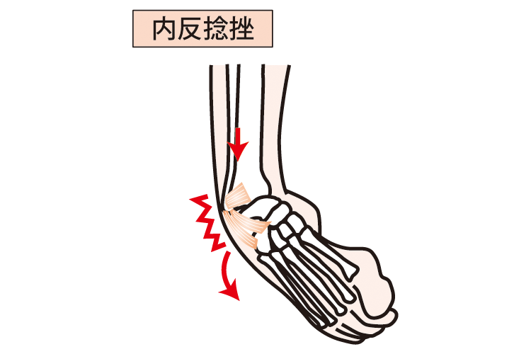 足関節捻挫画像