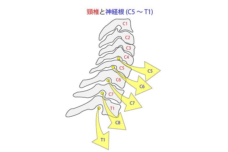 頚椎症神経根症画像