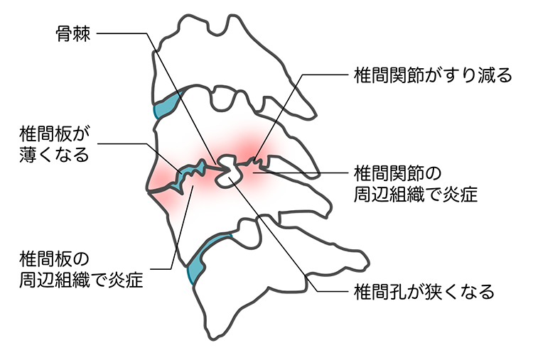 頚椎症神経根症画像