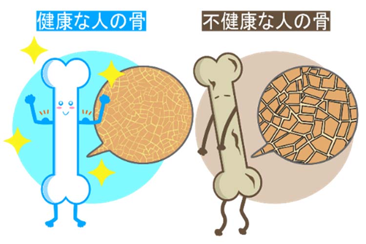 骨粗しょう症イメージ