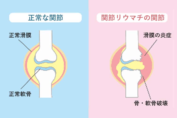リウマチ科イメージ