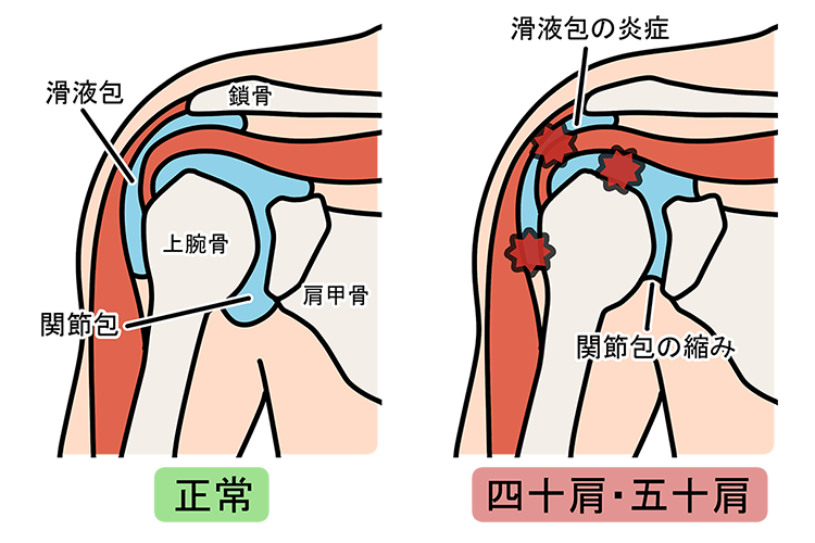 肩関節周囲炎（四十肩・五十肩）画像