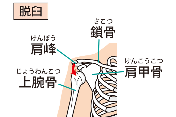 肩関節脱臼画像