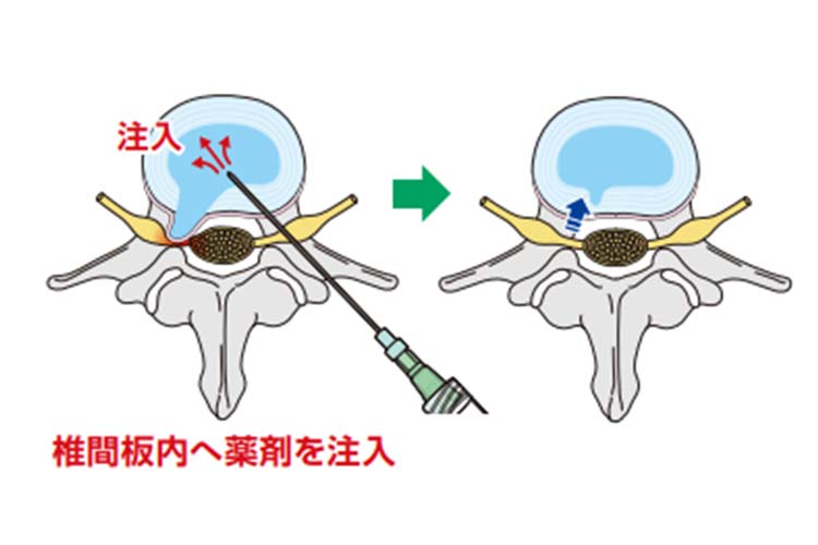 椎間板内酵素注入療法（ヘルニコア）画像