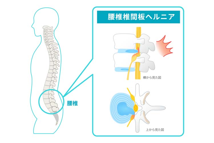 腰椎椎間板ヘルニア画像