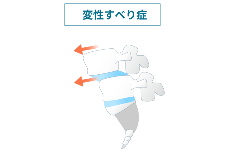 腰椎すべり症画像