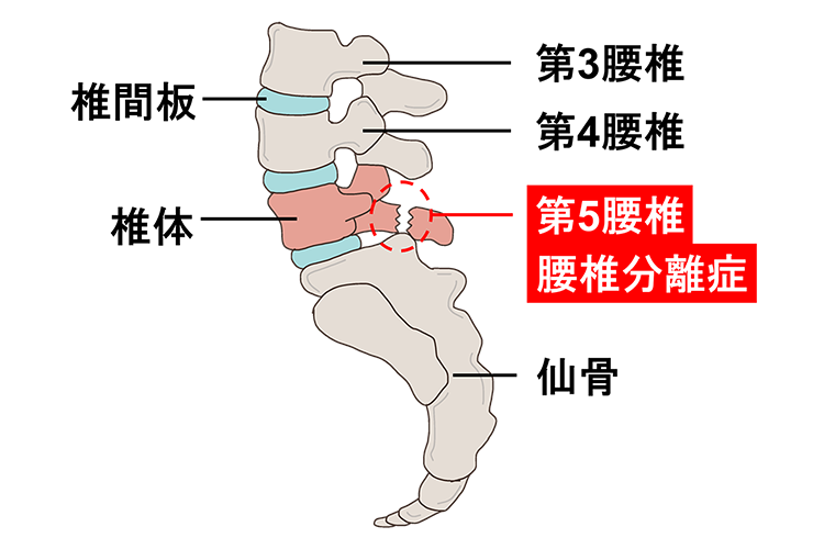 腰椎分離症画像