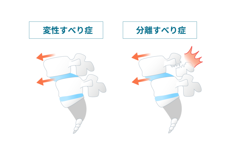 腰椎分離すべり症画像