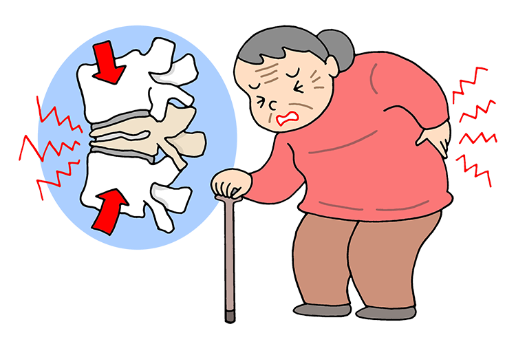 脊椎圧迫骨折（骨粗しょう症）画像